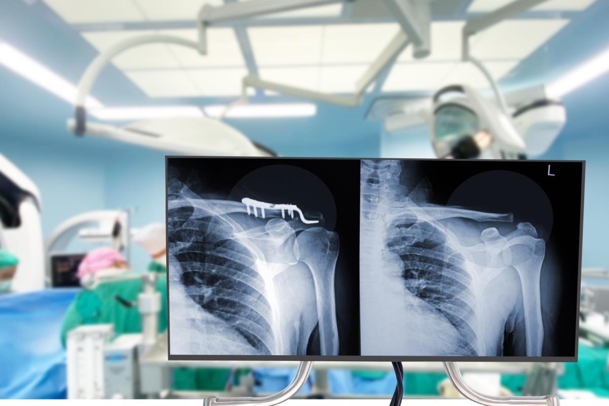 radiografii fractura de clavicula interventie chirurgicala ortopedica suruburi in clavicula