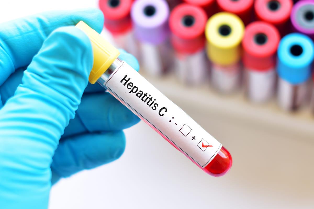 test de sange pentru diagnosticarea unui caz de hepatita c